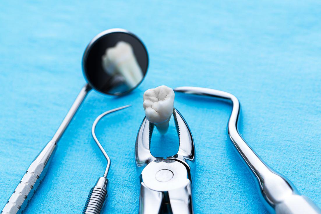 5 Common Reasons for a Tooth Extraction