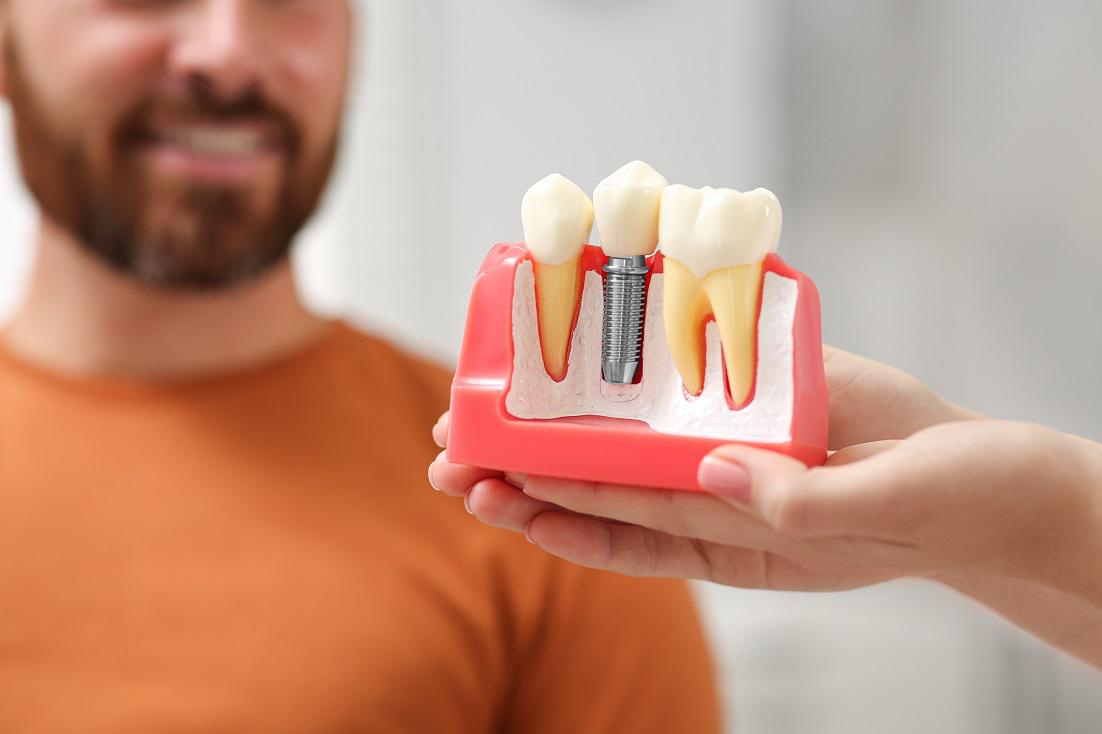 Unraveling the Science: How Do Dental Implants Stay in Place?