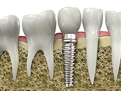 Dental Implants Sarasota FL